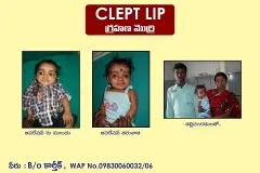 Cleft Lip