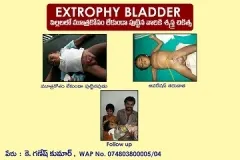 Bladder Exstrophy